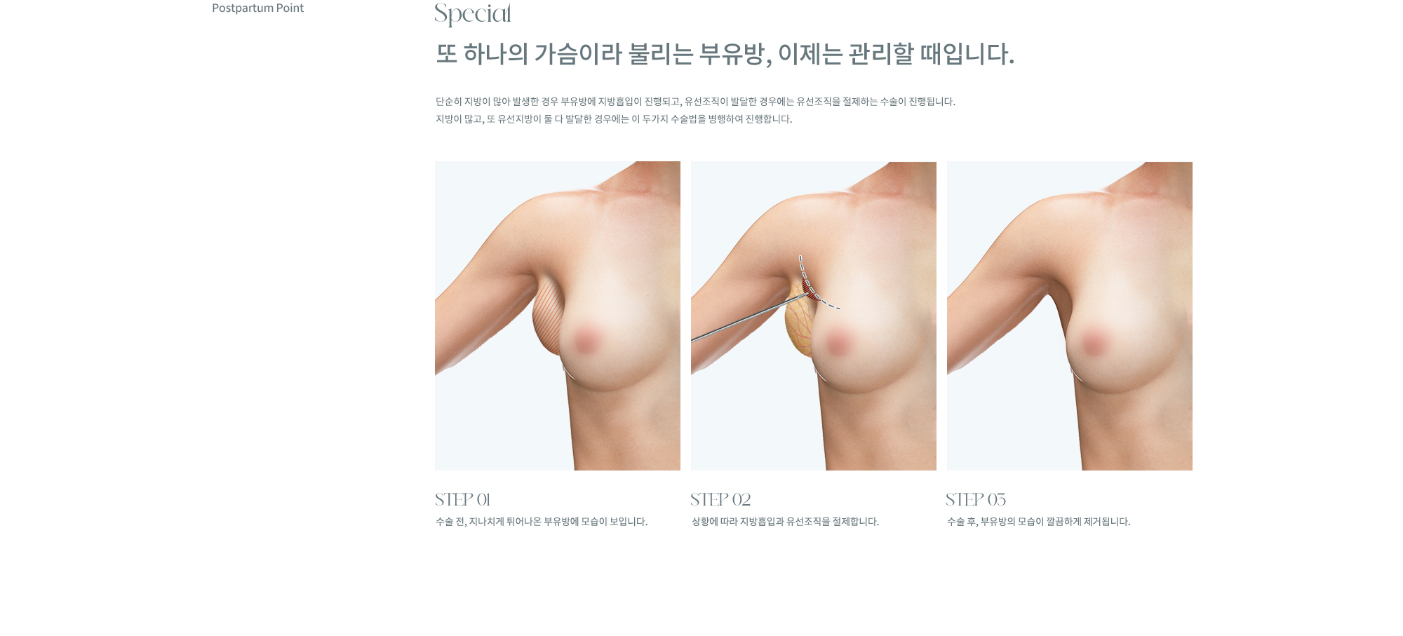 부유방 성형