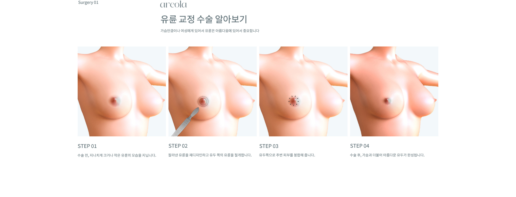 유륜/유두교정