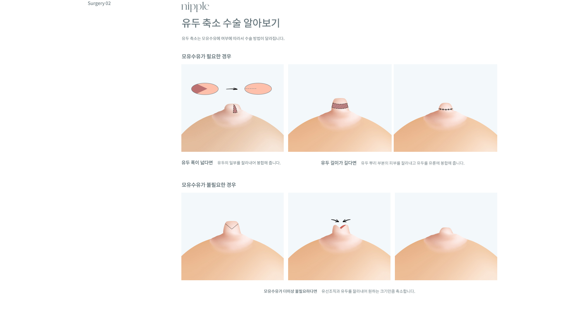 유륜/유두교정