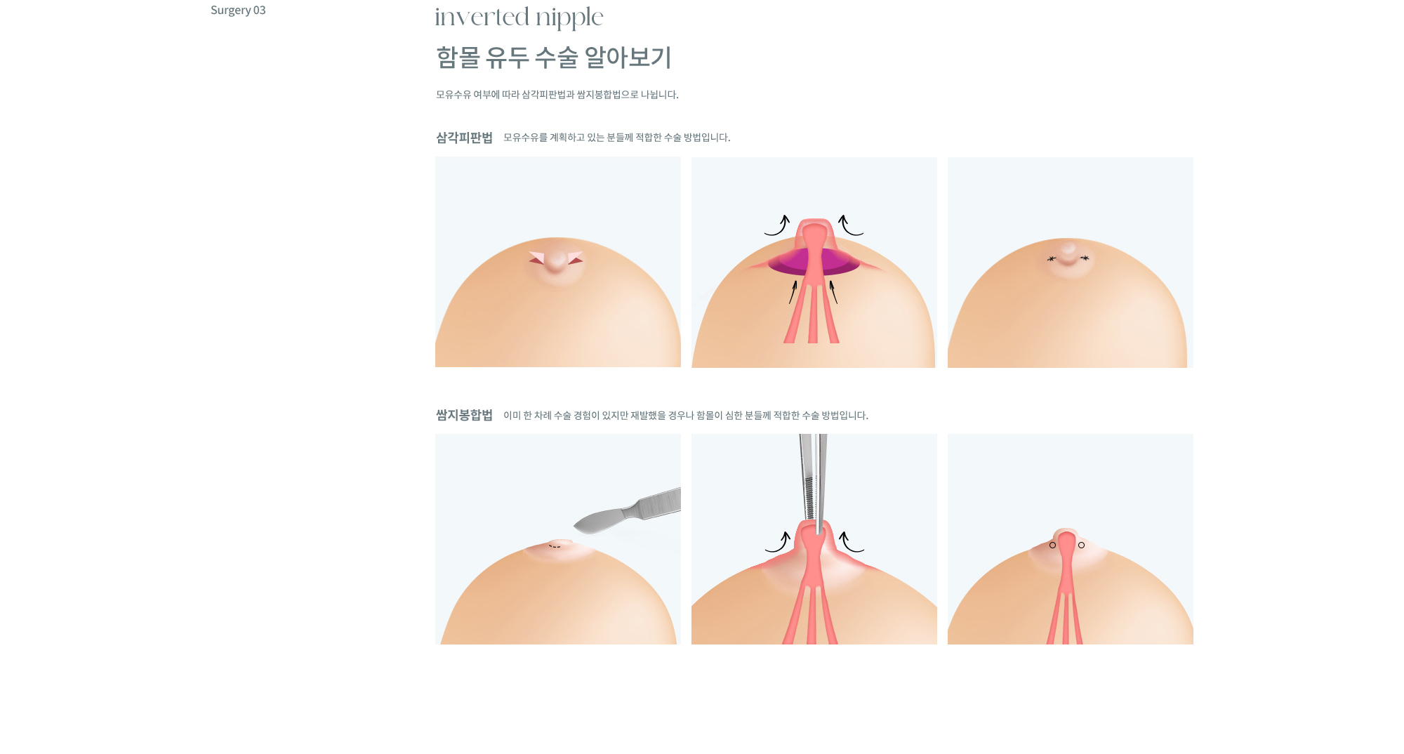 유륜/유두교정