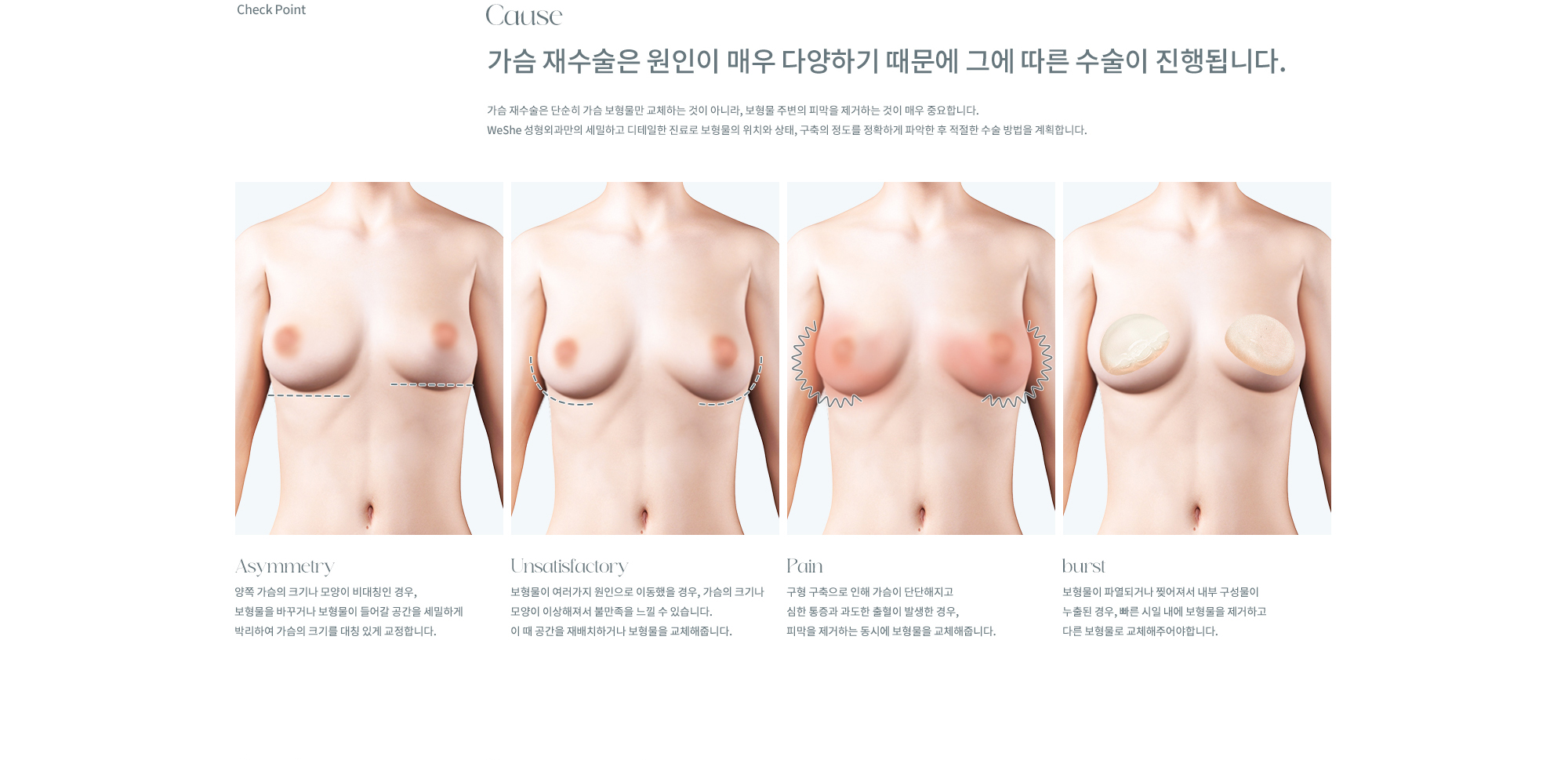 가슴재수술